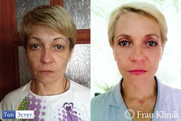 Ирина Дворецкая до и после подтяжки лица