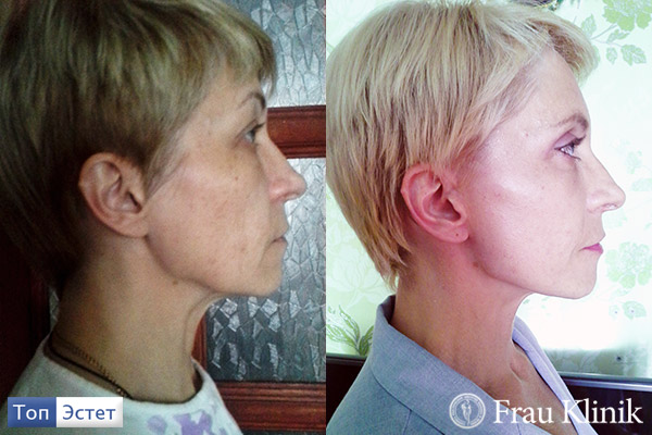 Ирина Дворецкая до и после пластической операции